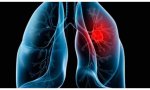 La tromboembolia pulmonar (TEP) es una de las principales causas de morbilidad y de mortalidad en todo el mundo